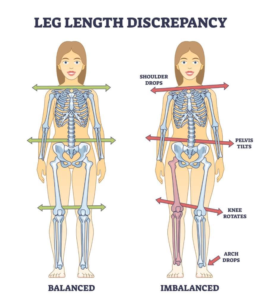 One leg longer than the other? Leg length discrepancy test and